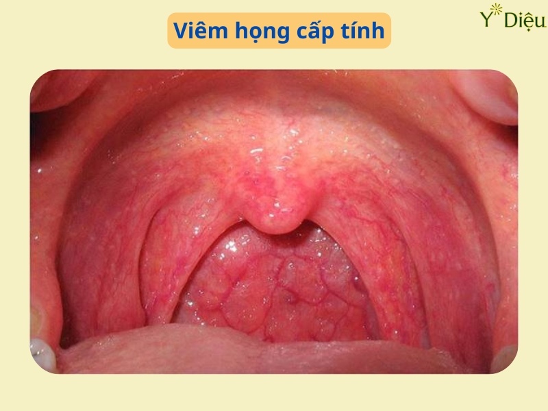 Ho Do Viêm Họng Cấp Tính: Nguyên Nhân Và Cách Điều Trị